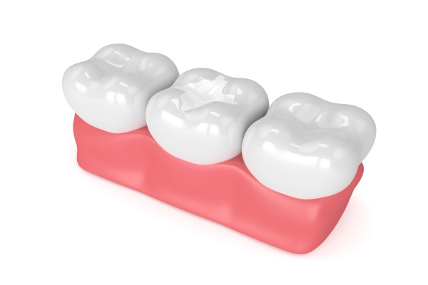 Dental Fillings For Kids: What Are They Made Of?